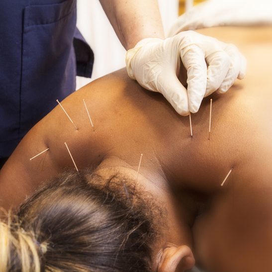 Patient receiving dry needling therapy on the shoulder with multiple needles inserted into trigger points, administered by a healthcare professional wearing gloves.