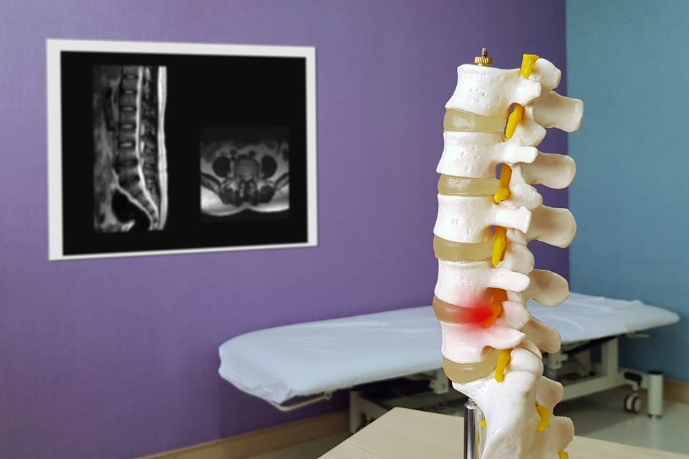 5 Ways to Treat a Herniated Disc
