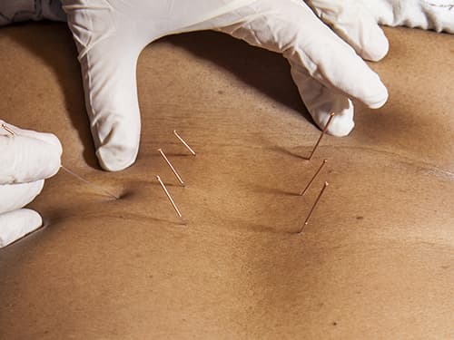 Close-up of a practitioner placing acupuncture needles into a patient’s back during a traditional acupuncture treatment, used to help relieve pain, reduce muscle tension, and support overall wellness.