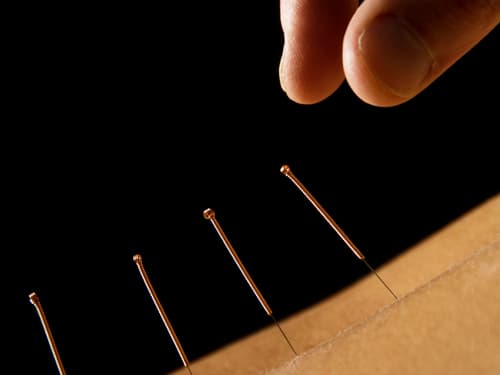Close-up of a practitioner placing fine acupuncture needles into a patient’s skin during an acupuncture treatment, highlighting a traditional therapy used for pain management, relaxation, and wellness support.