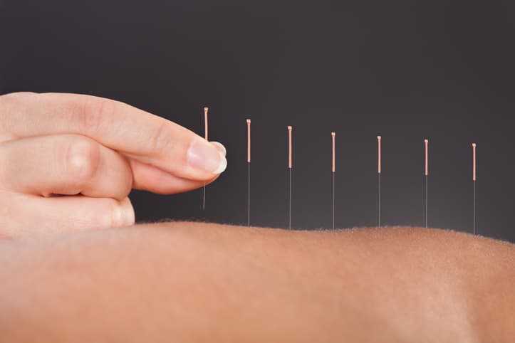 Acupuncture Needle Placement Acupuncture practitioner placing fine needles along a patient’s body during a professional acupuncture treatment.