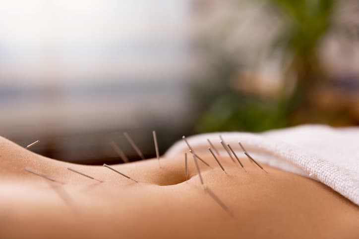 Acupuncture for Back Pain Relief Acupuncture needles placed along a woman's stomach during a professional acupuncture treatment.