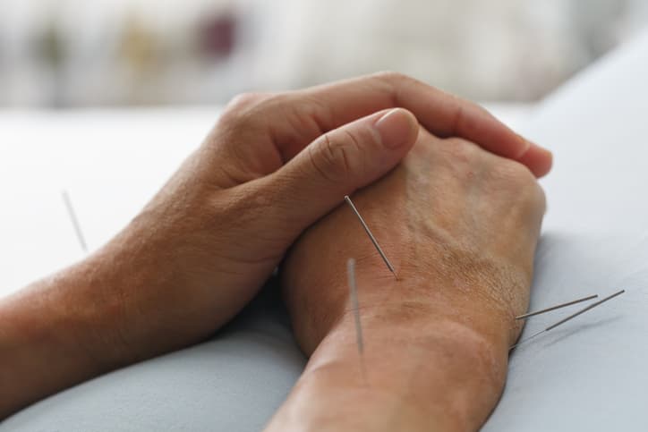 Acupuncture for Hand and Wrist Pain Acupuncture needles placed around a patient’s hand and wrist during a professional acupuncture treatment.