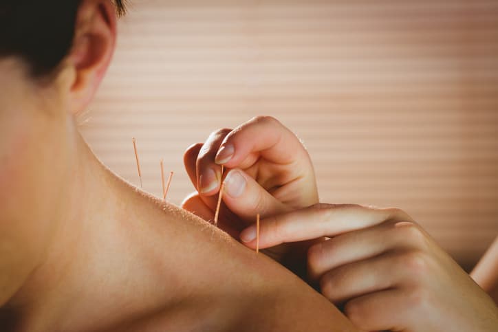 Acupuncture for Neck and Shoulder Pain Acupuncture practitioner placing fine needles around a patient’s neck and shoulder during a professional acupuncture treatment.