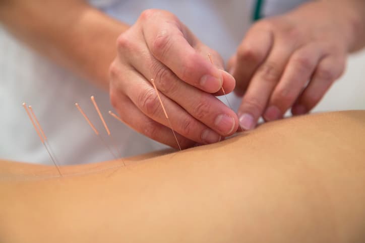 Acupuncture for Pain Relief Acupuncture practitioner placing fine needles into a patient’s leg during a professional acupuncture treatment.
