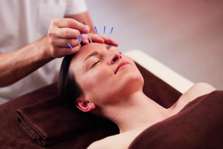 Facial Acupuncture Treatment Acupuncture practitioner placing fine needles around a patient’s forehead during a professional facial acupuncture treatment.
