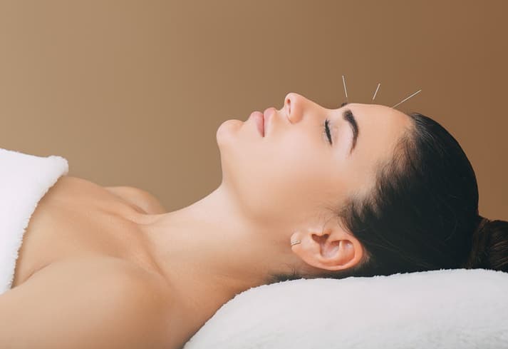 Facial Acupuncture Treatment Woman relaxing with fine acupuncture needles placed around her forehead during a professional facial acupuncture treatment.