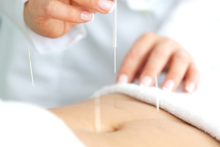 Professional Acupuncture Treatment Acupuncture practitioner placing fine needles into a patient’s abdomen during a professional acupuncture treatment.